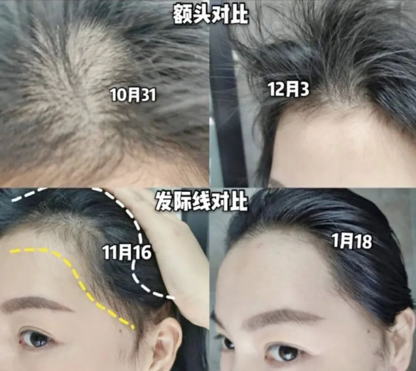 脫發者自述治脫上岸經歷，達霏欣提醒發友科學用藥